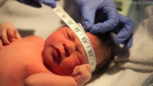 Reportan primer caso de bebé nacido con microcefalia en Florida 1 Reportan primer caso de bebé nacido con microcefalia en Florida